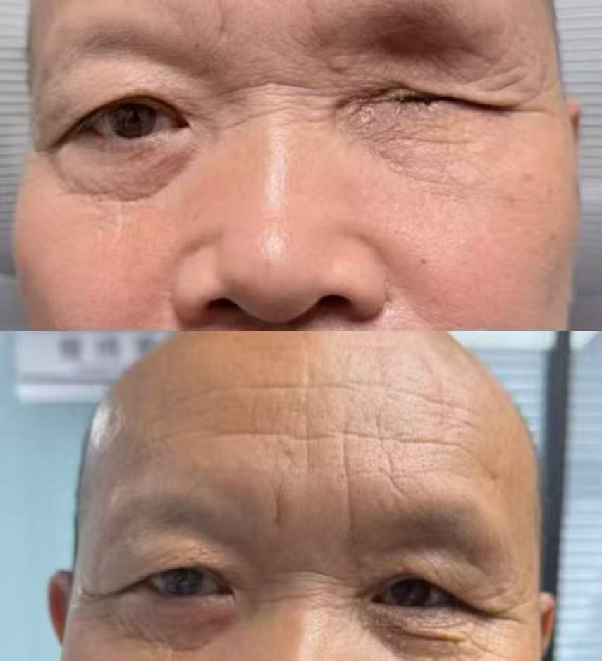 眼球摘除义眼定制案例