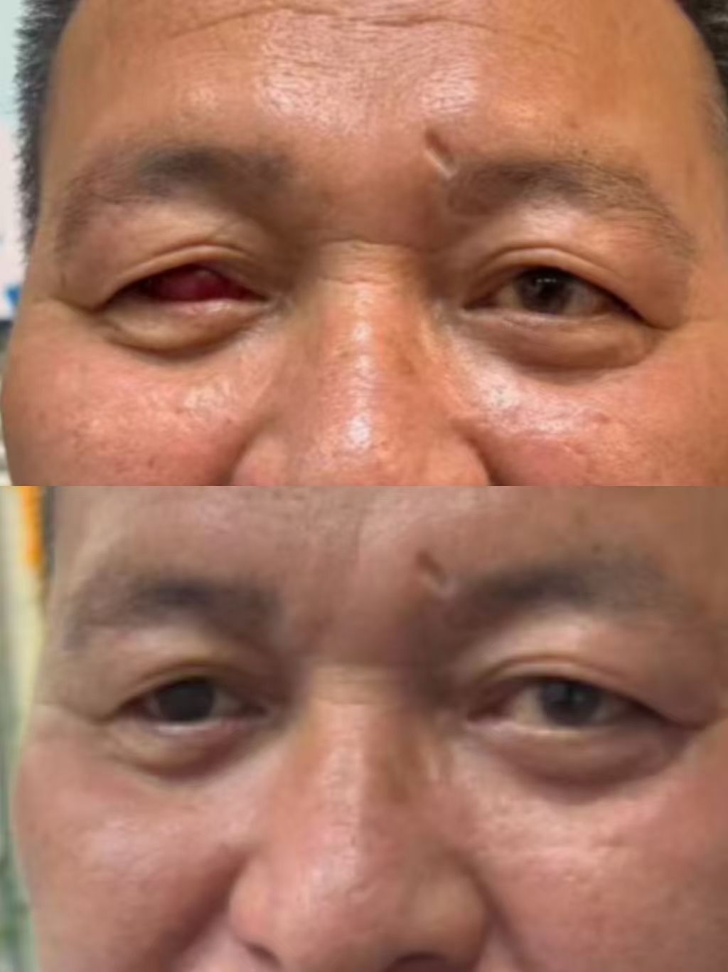 眼外伤义眼升级定制案例