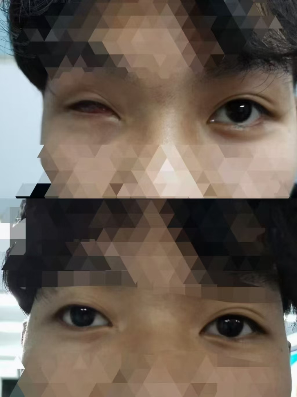 眼窝凹陷义眼定制案例