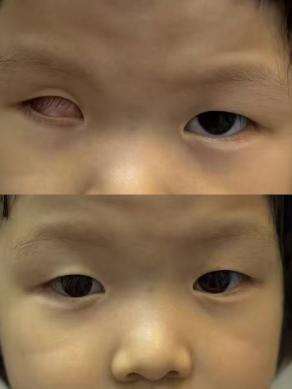 儿童义眼定制案例