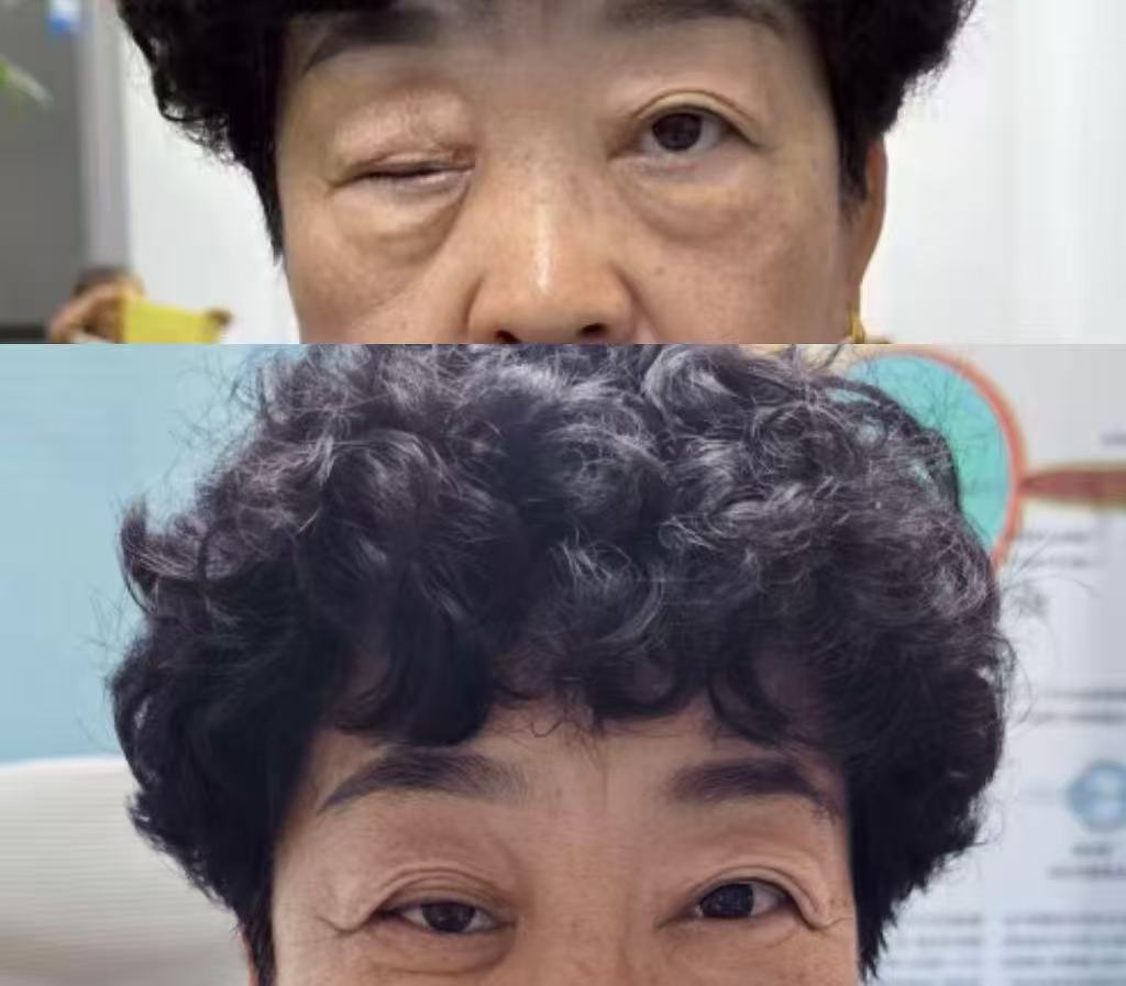 眼球萎缩义眼定制案例