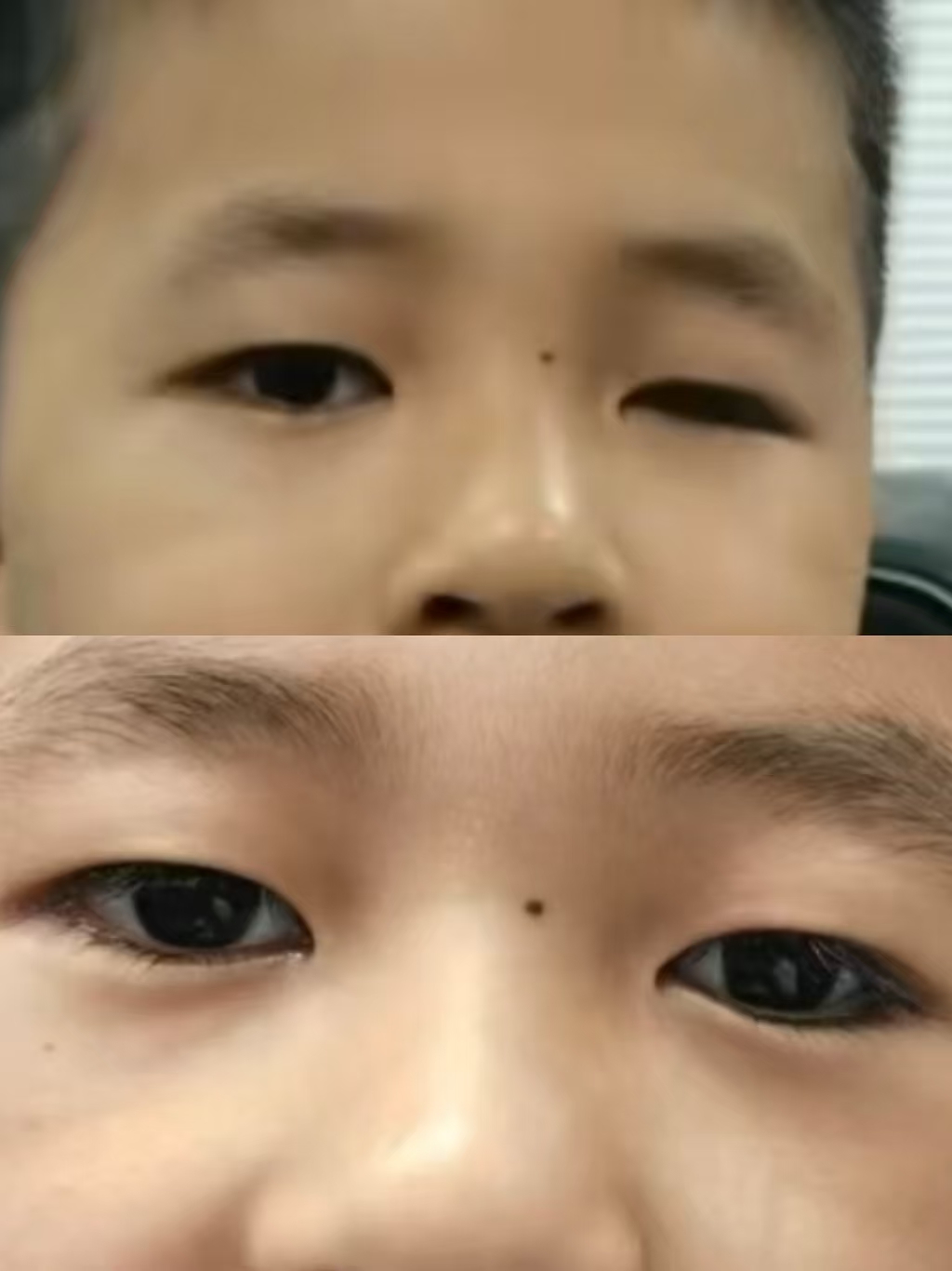 先天性小眼球义眼定制案例