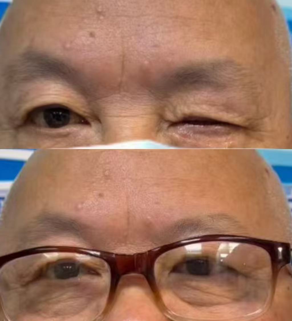 外伤致眼损义眼定制案例