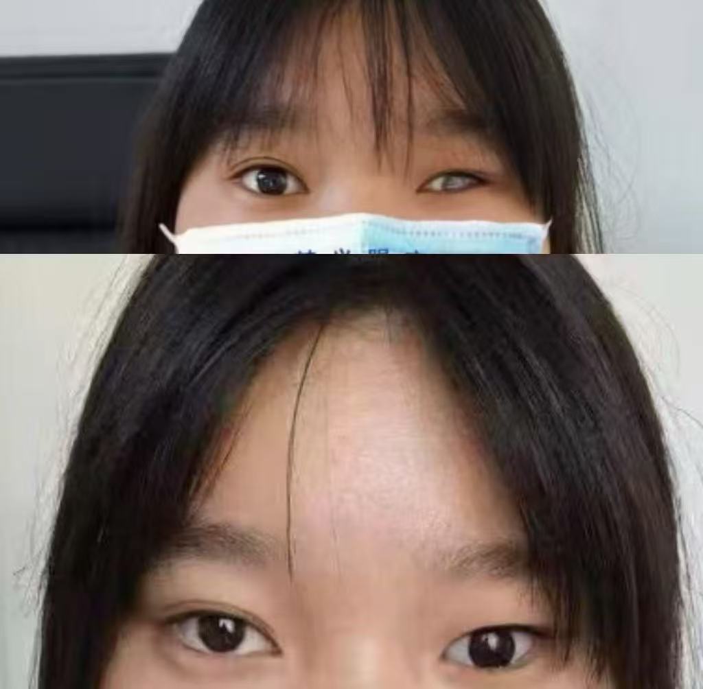 眼窝凹陷修复案例