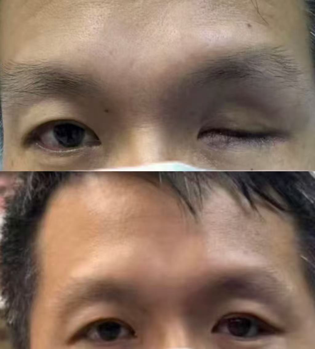 旧义眼升级焕新案例