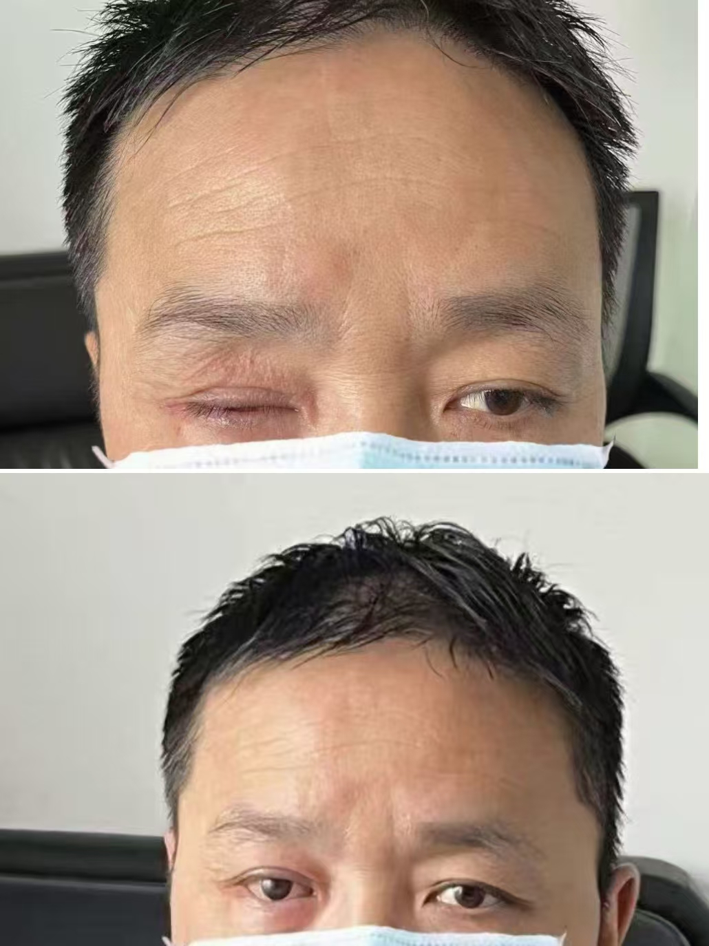 眼球摘除义眼定制案例