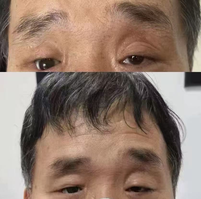 眼球萎缩义眼定制案例