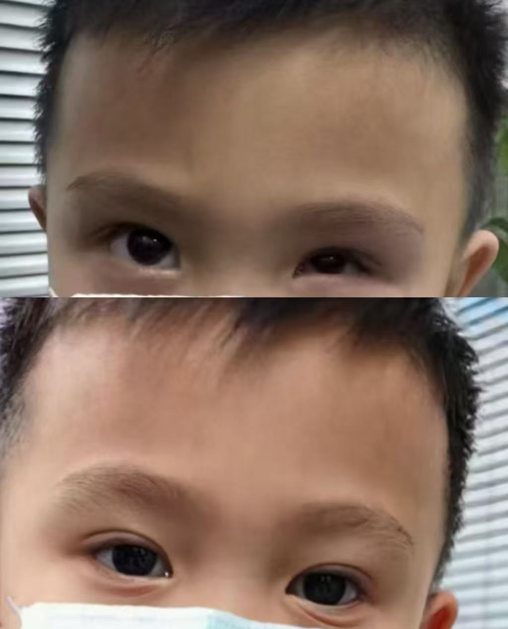 先天性小眼球义眼定制案例